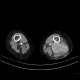 Liposarcoma of thigh: CT - Computed tomography